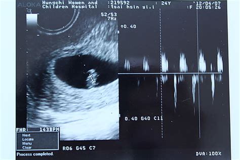 懷孕 七 週 心跳